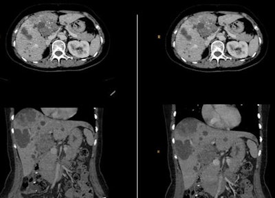Left: Filtered back projection images using Brilliance iCT. Scan Parameters: 120 kVp, 73 mAs, 23.7 cm coverage, 3.6 s scan time, 2.3 mSv. Right: Iterative reconstruction using iDose4. Scan parameters: 120 kVp, 33 mAs, 23.7 cm coverage, 3.6 s scan time, 1.2 mSv. This patient was scanned as a follow-up for multiple lesions in the liver and a mass in the abdominal cavity. The original scan was performed at 73 mAs and 2.3 mSv, and the follow-up scan was performed at 33 mAs and 1.2 mSv, without sacrificing image quality.All images courtesy of CMU Shengjing, People's Republic of China.