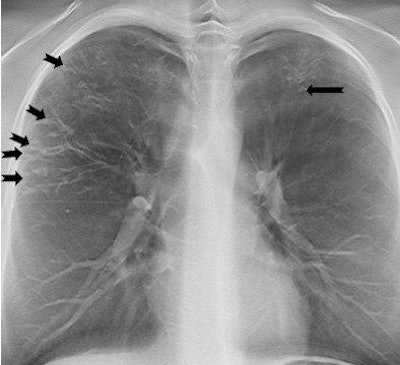 On a tomosynthesis section, cylindrical bronchiectases in the right upper lobe and small mucus plugs in a tree-in-bud pattern in the periphery of the lobe (arrows) are seen, but are not apparent on the AP radiograph. In the apical part of the left upper lobe, small cylindrical bronchiectases and mucus plugs (arrow) are seen.