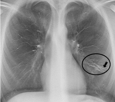 Another tomosynthesis section shows a slightly varicose bronchiectasis with severe wall thickening (circle) in the lingula segment of the left upper lobe. Small mucus plugs are seen in the area (arrow).