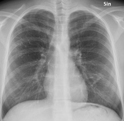 The anteroposterior (AP) chest x-ray, which is automatically included in the examination, shows increased linear markings in the right upper lobe and small parenchymal changes in the left lung, lateral to the heart. All images courtesy of Dr. Kristina Vult von Steyern.