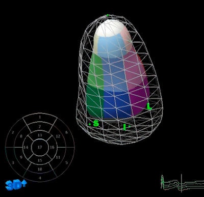 These images show left ventricular systolic function measured with 3D echocardiography in endurance athletes. Above: 3D echocardiography in systole of endurance athletes.Below: 3D echocardiography in diastole of endurance athletes. They were created using QLab software from Philips Healthcare.