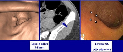 A sessile polyp 7-8 mm missed at optical colonoscopy was seen at CTC and confirmed at repeat colonoscopy. Histology revealed the presence of a low-grade adenoma. All images courtesy of Dr. Philippe Lefere.