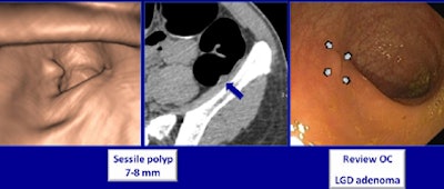 A sessile polyp 7-8 mm missed at optical colonoscopy was seen at CTC and confirmed at repeat colonoscopy. Histology revealed the presence of a low-grade adenoma. All images courtesy of Dr. Philippe Lefere.