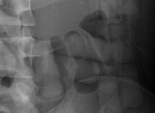 Top left: Low-dose linear slit digital radiography (LSDR) of a typical body packer with 145 intracorporal packs along the alimentary tract. Bottom left: Magnified view of the packs. Note the radiolucent rim within the periphery of the packs due to air trapping creating the so-called 'double-condom sign' and 'halo sign.' Top right: DR of a typical body packer with 83 cocaine packs in the gastrointestinal tract. Bottom right: Note the longitudinal packs (weight approximately 10 to 12 g) projecting over the colon. The magnified view depicts the typical 'double-condom sign' due to inevitable air trapped within the wrapping layers during manufacture.