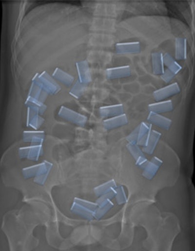 Left: LSDR of a typical body packer with a multitude of cocaine packs within the alimentary tract. Right: Same image with highlighted intestinal packs.
