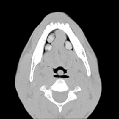 Three pellets under the tongue