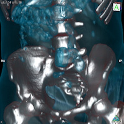 Top left: Axial plane in pulmonary window showing three pellets underneath the tongue. Top right: 3D reconstruction of an incidental finding of three sublingual cocaine pellets in a case of brawl/fist fight with subsequent CT and scan of the viscerocranium. The patient was immediately put under arrest and transferred to the affiliated custody ward. This scan was performed to rule out facial fractures sustained during the fist fight. Bottom left: Secured evidence of similar pellets (weight approximately 1 g). Bottom right: 3D reconstruction of gas-filled condom with two pouches (bags) of cocaine powder inside located in the descending colon. All images courtesy of Dr. Patricia Flach.