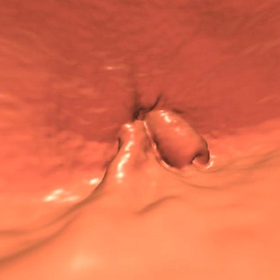 65-year-old patient developed a low rectal adenocarcinoma, stage II (T3, N0), three years after a negative screening VC