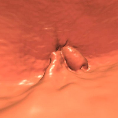 65-year-old patient developed a low rectal adenocarcinoma, stage II (T3, N0), three years after a negative screening VC