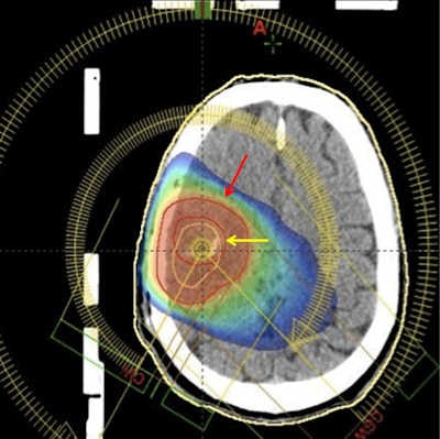 Radiation treatment planning of a brain tumor. Adding 11C-methionine PET increases the tumor volume (red arrow) when compared to the blood brain disruption as imaged by gadolinium-enhanced MRI (yellow arrow).