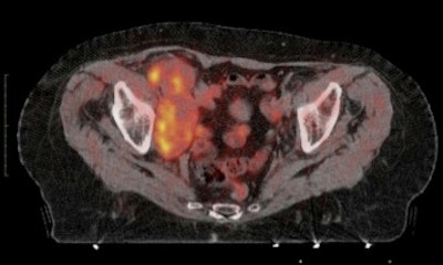 Example of the use of new radiopharmaceuticals: 11C-choline imaging of pathologic lymph nodes in advanced bladder cancer. Bulky disease in the right iliac region is easily recognized on PET/CT.