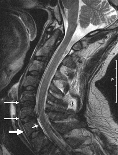 Sagittal T2 Weighted Image Shows A Focal Hematoma And Trace Of Prevertebral Hemorrhage