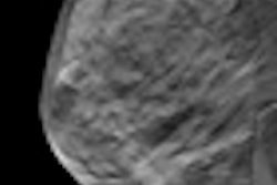 2012 01 09 11 57 32 726 Breast Tomo 70