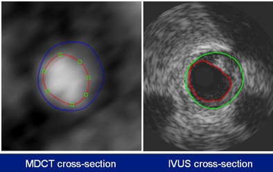 The MDCT analysis included the normal MDCT image, the MDCT gradient image, and the longitudinal vessel view. Quantitative parameters were determined per 1-mm cross-section and included the lumen area, the vessel area, plaque area, and maximum wall thickness. Plaque was deemed to be present when the wall thickness exceeded 0.5 mm. Regions of interest (ROI) plaque volumes were calculated as the sum of plaque volumes of all the ROI cross-sections. All images courtesy of Dr. Stella-Lida Papadopoulou.