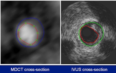 The MDCT analysis included the normal MDCT image, the MDCT gradient image, and the longitudinal vessel view. Quantitative parameters were determined per 1-mm cross-section and included the lumen area, the vessel area, plaque area, and maximum wall thickness. Plaque was deemed to be present when the wall thickness exceeded 0.5 mm. Regions of interest (ROI) plaque volumes were calculated as the sum of plaque volumes of all the ROI cross-sections. All images courtesy of Dr. Stella-Lida Papadopoulou.