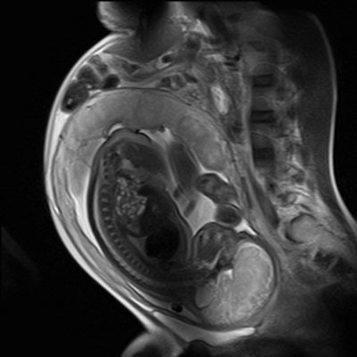 There is no firm evidence that clinical MR procedures during pregnancy produce adverse effects, the experts say. This sagittal half-Fourier acquisition single-shot turbo spin-echo (HASTE) image was used for planning further fetal images in other planes, and was taken at the Clinical Research Imaging Center, University of Edinburgh. Image courtesy of Janet De Wilde, PhD, and Dr. Scott Semple.