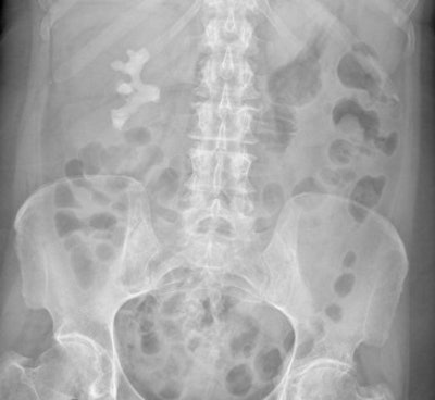 Digital abdominal x-ray shows large staghorn renal calculus, which is the white density below the ribs. But are such investigations of any great value when CT and ultrasound are more sensitive?