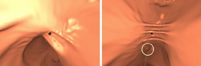 Prone-supine registration example