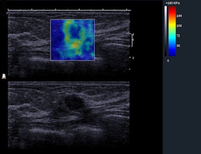 BE1 SWE of a heterogeneous lesion that proved to be malignant. This impalpable lesion was found at mammography in a 66-year-old patient. On B-mode, the investigator scored the lesion as BI-RADS 4a. The heterogeneous pattern on the elasticity map confirmed the level of suspicion. The pathological outcome was a mixture of invasive and in situ ductal carcinoma. Image courtesy of Dr. Fritz KW Schäfer, University Hospital, Schleswig-Holstein in Kiel, Germany.