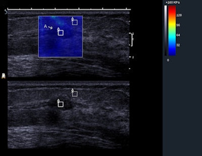 BE1 SWE of a benign mass showing the QBox. This palpable lesion was scored as BI-RADS 4a by the investigator, suggesting it carried a risk of malignancy, but it was soft on SWE with very low Emax values (20 kPa), suggesting that it was benign. Histology of the biopsy specimen revealed a fibroadenoma. Image courtesy of Dr. Christophe Tourasse, Hôpital Louis Mermoz in Lyon, France.