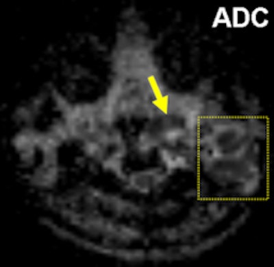 The same patient as seen on postcontrast fat-saturated T1 weighted (left), respectively. Left-sided peripherally enhanced, mostly necrotic, lymphadenopathies (dashed circle) are present on level 2 on axial short tau inversion-recovery and axial postcontrast fat-saturated T1-weighted images. Accompanying minimal signal intensity change and increased thickness of neighboring soft-tissue planes are seen as well. Remarkable restriction of diffusion is illustrated within lyphadenopathies and left palatine tonsil (ADC = 0.82 mm/sn2) (right).