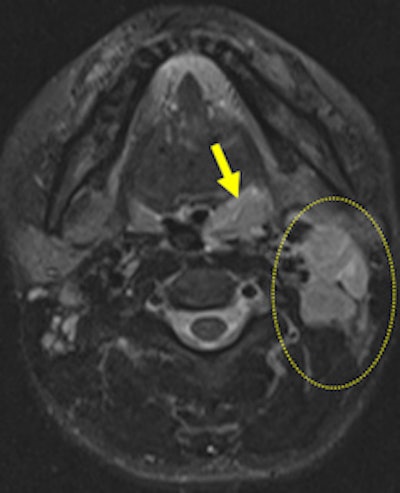 A 30-year-old woman suffering from oropharyngeal tularemia. She presented with painful left-sided cervical mass. Hypertrophic left palatine tonsil (arrow), narrowing oropharynx, isointense on T1-weighted and hyperintense on T2-weighted images compared with striated muscle with homogeneous contrast enhancement is seen on axial TSE T1-weighted (left), short tau inversion recovery (right). All images courtesy of Dr. Safiye Gürel.