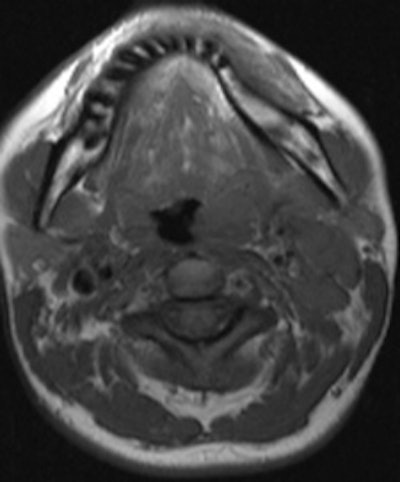 A 30 Year Old Woman Suffering From Oropharyngeal Tularemia