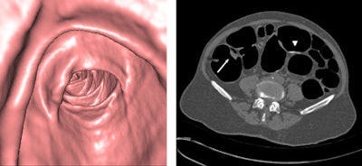 A 58-year-old woman at average risk of a colorectal neoplasm, who was asymptomatic. Left: 3D endoluminal image shows a 20 mm flat polyp (protruding less than 3 mm from the mucosa). Histology confirmed an adenocarcinoma located in the ascending colon (arrow). Right: 2D axial image confirms that the polyp identified in (left) is a soft-tissue lesion (arrow). Axial image shows no residual fluid in left and right colon (score 5). Score of 4 and 5 in sigmoid (arrowhead) for quantity and tagging residual fluid. Distension score of 5 in the whole colon. Image courtesy of Dr. Carmen Zueco Zueco.