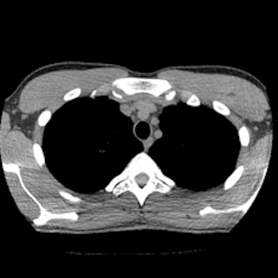 Chest CT images with reconstructions using different kernels; slices at the same position at the mediastinal level (Aquilion One, Toshiba Medical Systems). Left: Initial chest CT, reconstructed with the standard kernel (FC14). Right: Follow-up CT, reconstructed with a new, dedicated, dose-saving kernel (FC14). It becomes obvious that diagnostic image quality is maintained, despite more noise and artifacts using the new 'dose-saving' kernel (right). All images courtesy of Dr. Erich Sorantin.