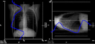 Screenshot from CT console depicting chest scout view. The horizontal axis represents the dose, the vertical axis slice positions -- the blue line indicating the dose requirements on a particular position at a given noise level. It can be perceived that on the lower chest part dose requirements approximate less than 25 mA.