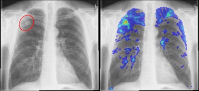 Izquierda: Radiografía de tórax de un paciente con tuberculosis comprobada por cultivo. Se observa una pequeña lesión en el lóbulo superior derecho. Derecha: Resultado de un sistema CAD: Las localizaciones altamente sospechosas están marcadas en rojo, mientras que las áreas menos sospechosas se indican en azul. Todas las imágenes son cortesía del Dr. Laurens Hogeweg.