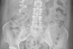 La radiografia digitale dell'addome dimostra un grossolano calcolo renale con aspetto 'staghorn' (a corna di cervo), corrispondente all'opacità localizzata caudalmente all'emicostato destro. E' opportuno chiedersi se questo tipo di indagine abbia qualche valore, considerata la maggiore sensibilità di TC ed ecografia.