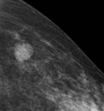Benign postoperative scarring. The distortion and trapping of the fat lobules and oil cysts are seen on both examinations but the photon-counting tomosynthesis offers better delineation and thus improves certainty of the less experienced reader.