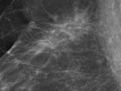 Benign postoperative scarring