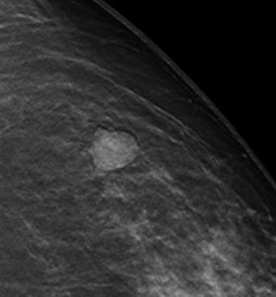 Benign postoperative scarring