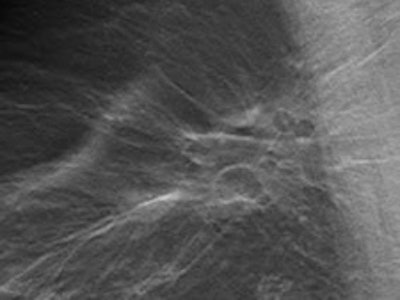 Benign postoperative scarring