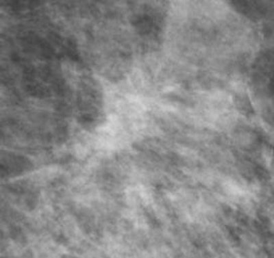 A malignant spiculate mass in the right upper outer quadrant is seen better on photon-counting tomosynthesis. All images courtesy of Dr. Matthew Wallis.