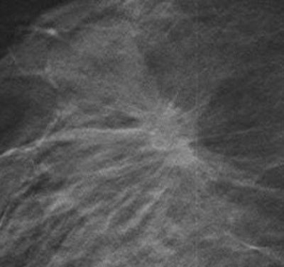 A malignant spiculate mass