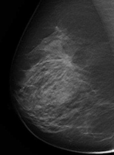 A malignant spiculate mass