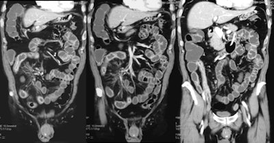 Small-bowel CT enteroclysis. Crohn's disease extended throughout the ileum, with thickened wall and typical enhancement of the mucosal layer. Fibrofatty proliferation of the mesentery, also known as creeping fat, is visible. Image courtesy of Dr. Gian Rollandi of Ospedali Galliera in Genoa, Italy.