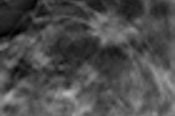2012 02 06 12 19 54 711 2012 02 07 Breast Tomo Thumb