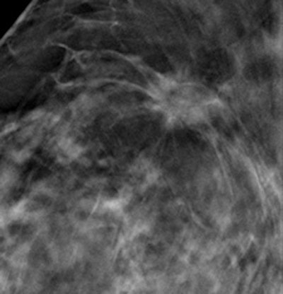 Example of improved screening with 3D imaging with tomosynthesis -- a cancer stellate opacity with distortion with tomosynthesis (right) and with standard mammography (left).