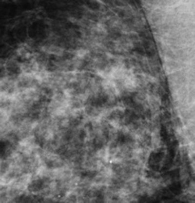 Standard mammography