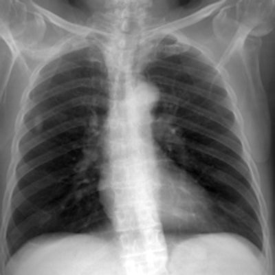 2012 02 15 18 04 44 486 2012 02 17 Chest Radiography 2a
