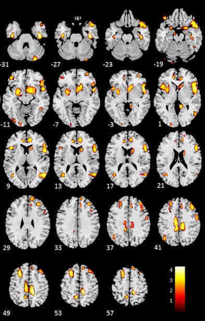 Areas of gray-matter deficiency are shown in yellow. Compared with healthy controls, participants with heart failure showed the greatest loss of gray matter in the left cingulate, the right inferior frontal gyrus, the left middle and superior frontal gyri, the right middle temporal lobe, the right and left anterior cingulate, the right middle frontal gyrus, the inferior and precentral frontal gyri, the right caudate, and the occipital-parietal regions involving the left precuneus. Image courtesy of Dr. Osvaldo Almeida, PhD.