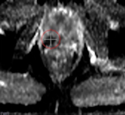 A 69-year-old male three years post electron-beam radiation therapy (EBRT, primary PC: Gleason 4+3 right PZ) with PSA increase to 2. MRI and TRUS-guided biopsy of this area confirmed Gleason 4+4 recurrence at right PZ (old tumor location). Left: Axial T2-weighted MR image shows low signal prostate due to previous EBRT. Therefore, tumor (arrow) is difficult to see. At arrow, there is some 'bulging' (PI-RADS 5). Center: Axial DCE-MRI shows increased focal asymmetric contrast leakage at right PZ (circle, PI-RADS 5). Right: Axial ADC-map of DWI-MRI shows restriction (low signal, circle, PI-RADS 5). Final diagnosis: PI-RADS 5. TRUS biopsy of this area confirmed Gleason 4+4 recurrence.