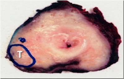 A 48-year-old sexually active male with PSA 9; TRUS biopsy Gleason 4+3 PC at right PZ; stage T1c. Nerve-sparing prostatectomy was performed showing submillimeter ECE and negative resection margins. Postsurgery patient was potent and continent. Left: Axial T2-weighted MR image shows low signal tumor in right PZ (white area) with obliteration of the white fat at the rectoprostatic angle (arrows), indicating minimal ECE = PI-RADS 5. The NVB is indicated by red, blue, and yellow. Right: Nerve-sparing prostatectomy showed Gleason 4+3 PC with submillimeter ECE (T; blue area) at right PZ. Resection margins were negative. Patient was potent after surgery.