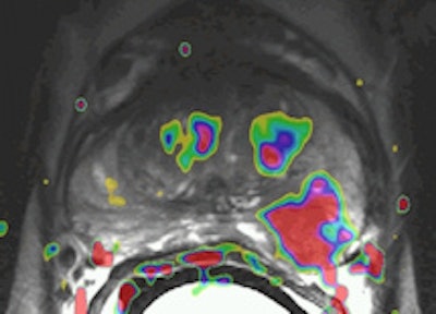 A 56-year-old male with prostate-specific antigen (PSA) level of 11; transrectal ultrasound (TRUS) biopsy, Gleason 3+4 left; DRE T1c. Prostatectomy confirmed Gleason 4+3 prostate cancer (PC) with extracapsular extension (ECE) in left peripheral zone (PZ). Left: Axial T2-weighted MR image shows low-signal lesion in the left PZ (white outline), which fits PC with ECE (arrow, PI-RADS 5). Right: Axial dynamic contrast-enhanced MR image shows asymmetric focal enhancement both in tumor in left PZ, with curve type 3 (PI-RADS 5). All images courtesy of Dr. Jelle Barentsz.