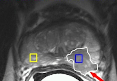 Prostate MRI