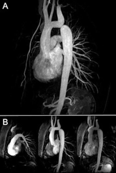 A: Single-dose (0.1 mmol/kg body weight) high-resolution (0.8 x 0.8 x 0.8 mm3) MR angiography in coarctation of the aorta (CoA). B: 3-tesla dynamic MR angiography performed at high temporal and spatial resolution. Images courtesy of Dr. Bernd Wintersperger.